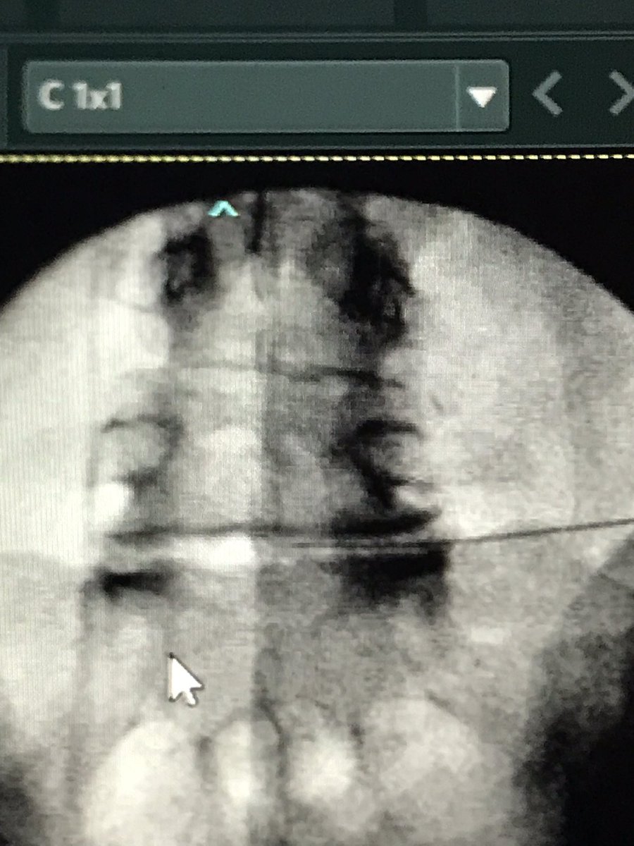 DraCBatet's tweet photo. Hoy hemos iniciado en nuestra Unidad de Dolor @ConsorciCSI el tratamiento de #dolordiscal #discopatía mediante Láser y PRP. Nuevas perspectivas para tratar el #dolorencolumnavertebral. @SEMDOR2 #herniadiscal #protusiondiscal @ranm_es https://t.co/nRXVIi7ABB