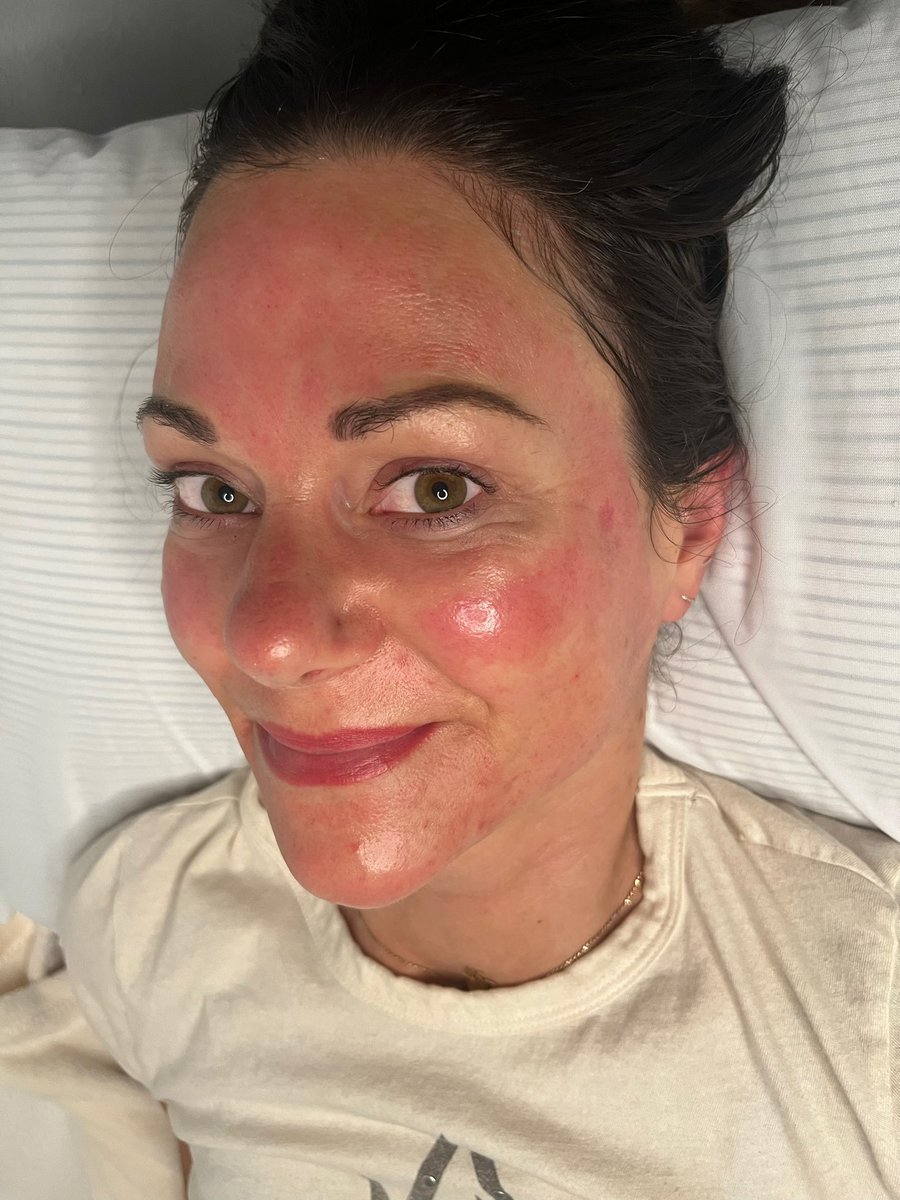 everythingbody_'s tweet photo. Everything Microneedling Facial🤍

#yycbeauty #calgary #yyc #yyccalgary #calgary_yyc #calgaryesthetics #calgaryesthetician #yycesthetician #microneedling #calgarymicroneedling #yycmicroneedling  #calgaryalberta #microneedlingtherapy #collageninductiontherapy https://t.co/fbmwmycPVs