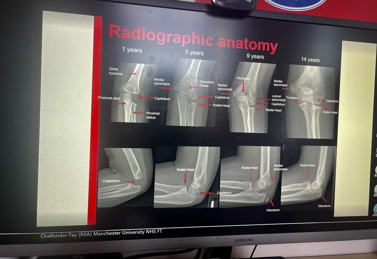 Dr Andrew Tootell SFHEA (@andrew_tootell) on Twitter photo The 2nd of <a href="/salfordrads/">Salford Radiography</a> new bite size #cpd sessions led again by <a href="/FayChall86/">Fay Challender</a> on the paed elbow following the last one on hips and pelvis. Great to see 80+ people online. Keep a look out for future events from October. #northwestimagingacademy. <a href="/mercer_claire/">Dr Claire Mercer</a> The 2nd of <a href="/salfordrads/">Salford Radiography</a> new bite size #cpd sessions led again by <a href="/FayChall86/">Fay Challender</a> on the paed elbow following the last one on hips and pelvis. Great to see 80+ people online. Keep a look out for future events from October. #northwestimagingacademy. <a href="/mercer_claire/">Dr Claire Mercer</a>