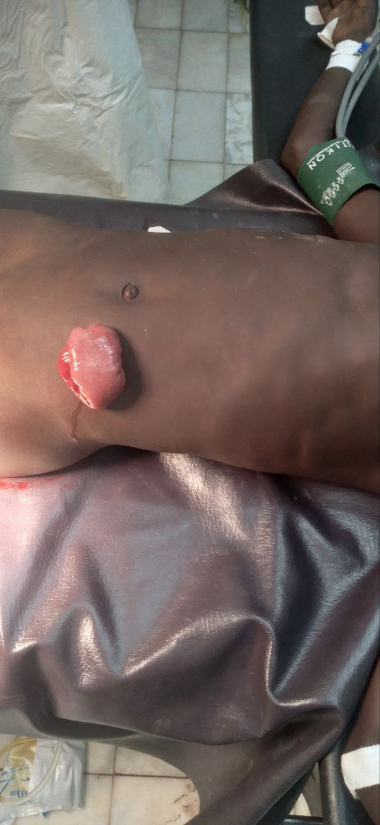 JekapOmod's tweet photo. A group of Nuer refugees attack Anyaali kebele in #Itang woreda today. One child was shot in the stomach, one woman in the wrist, and the other one in her hip. Again, these are happening while thousands of #ENDF and Federal Police are present in the area.
They disarmed the local militias and special forces for this purpose. The #GoE can’t defend the vulnerable, but they were so quick to disarm the militias. Why make people defenseless if you can’t guarantee them safety? This is a cruel and an inhumane thing to do to your own citizens.
#STOP using Nuer refugees to eradicate the #Anywaa indigenous population from their ancestral lands! We don’t want violent and killer refugees in our land! Relocate or repatriate them back to #South_Sudan.
@Refugees @UNHCREthiopia @UNHumanRights @WFP @AbiyAhmedAli @PMEthiopia @POEthiopia @mfaethiopia @KellyTClements