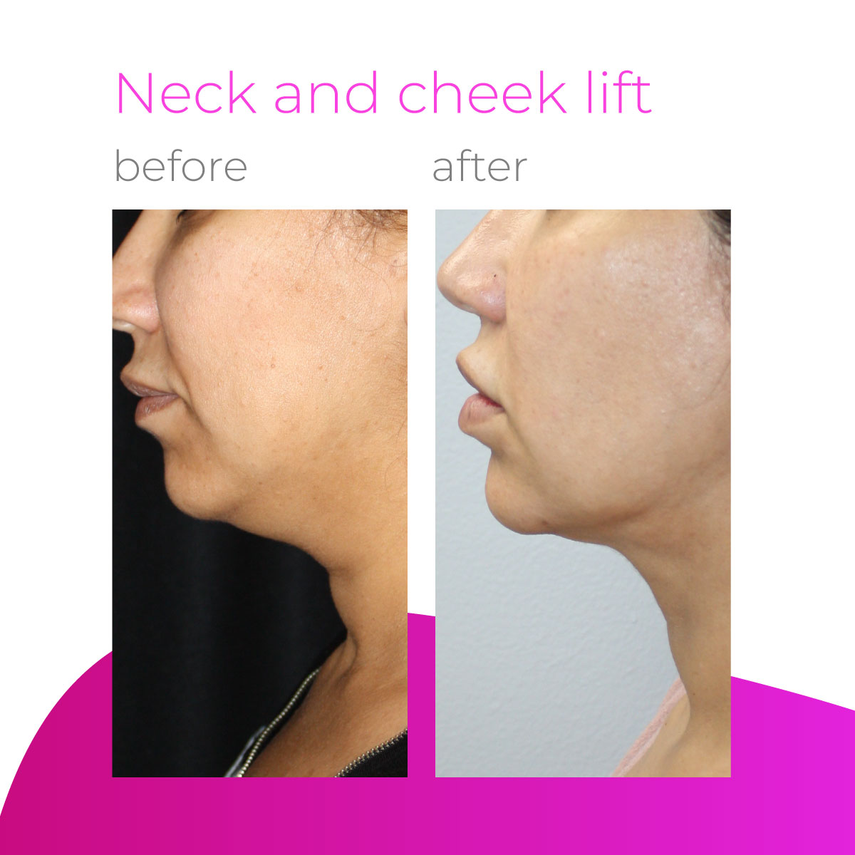 drfardadf's tweet photo. Experience the revitalizing effects of a neck and cheek lift! A neck and cheek lift is a transformative surgical procedure designed to address sagging skin, wrinkles, and loss of volume in the neck and cheek areas. https://t.co/Jl5sfgKHBX