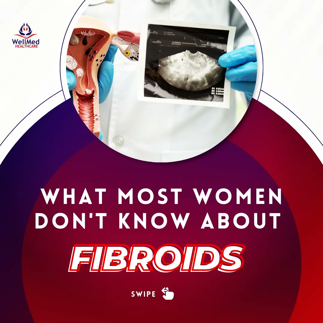 wellmedng's tweet photo. Did you know that fibroids may occur more in women who are overweight or obese because being overweight increases the level of oestrogen in the body?
Like and retweet!
#fibroid #fibroids #fibroidssuck #fibroidsolution #fibroidsymptoms #fibroidscure #oestrogen #fertility https://t.co/Wtkppos1Xy