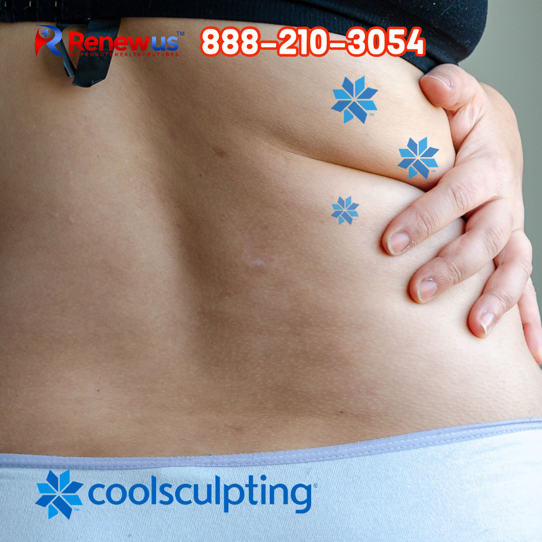 CoolSculpting fat-freezing technology is a non-surgical, proven way to reduce pockets of fat in trouble spots. You can see the differences on the abdomen, flanks, double-chin, upper-arms, thighs, bra fat, back fat, and underneath the buttocks. Freeze your fat away! 888-210-3054