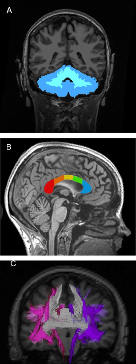 From the #RedJournal: First prospective evidence of association btwn cerebellar injury and processing speed in brain tumor pts, independent of damage to supratentorial WM. @MSalans @JHGlabed #btsm #ucsdradm bit.ly/salansijrobp