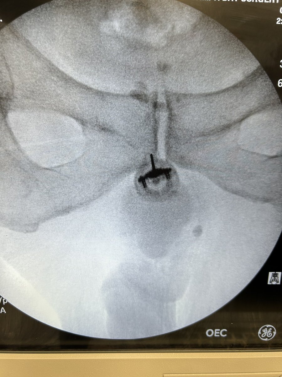 Perineal nerve is a branch of pudendal nerve, as is the dorsal nerve of penis. Here is a fluoroscopic technique to perform a combined perineal and dorsal nerve of penis block and cryoneurolysis #pelvicpain #penilepain #urology #men Patient presented with intractable penile pain
