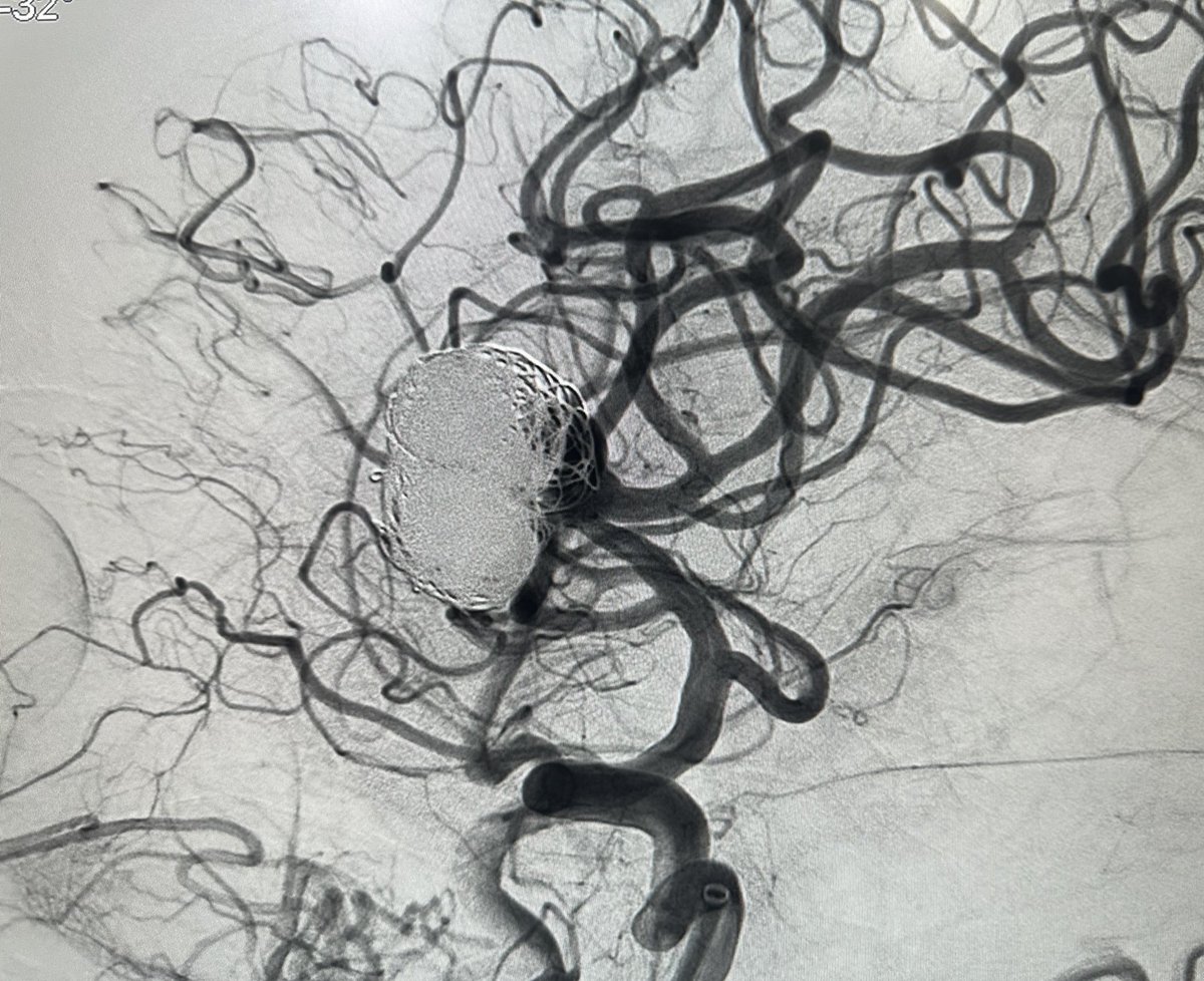 A large recanalization of an MCA aneurysm. Planned treatment: Stent Lvis Evo plus coils. A trick to overcome this tight angle of the MCA lower branch: we used a septer balloon inside the aneurysm to redirect the microguide, the Lvis Evo stent was deployed and aneurysm coiled.