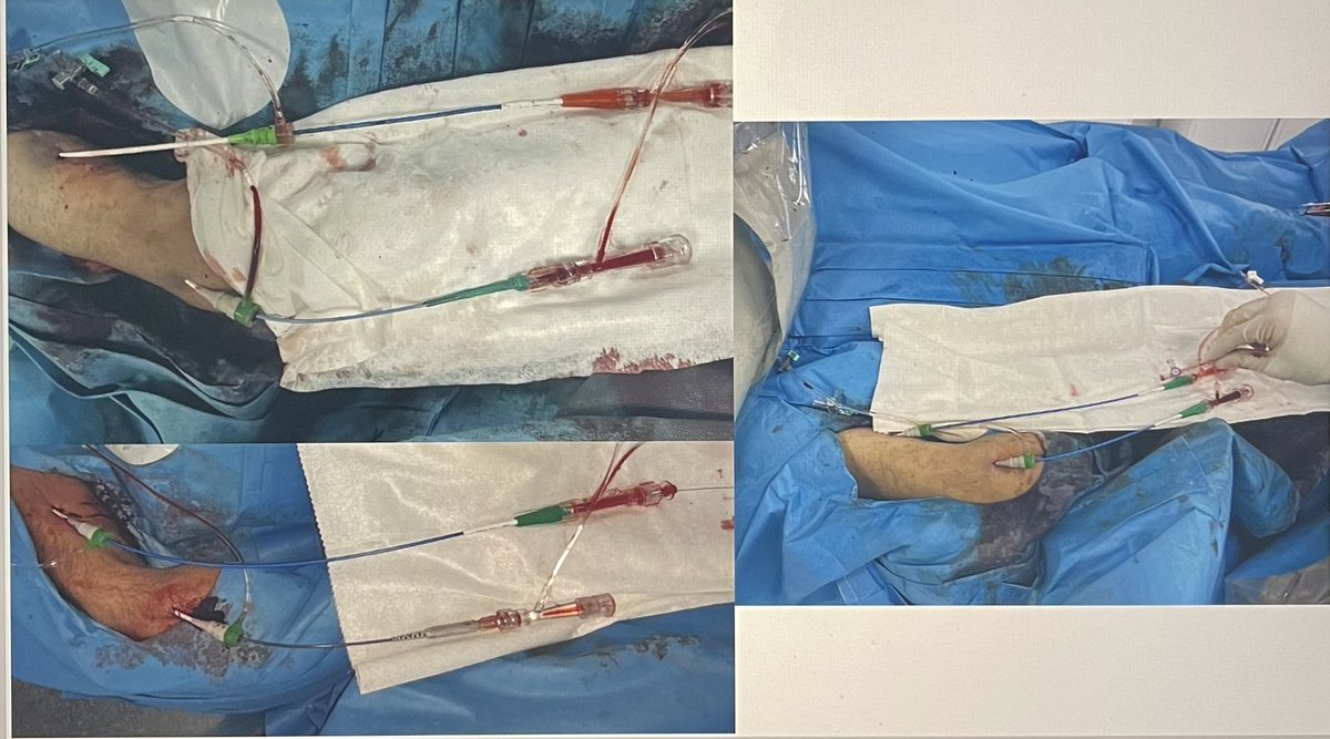 <a href="/KPujdak/">Dr. Krzysztof Pujdak</a> <a href="/AgostoniPF/">Pierfrancesco Agostoni</a> <a href="/KovacicMihajlo/">Mihajlo Kovacic 🫀📕/🔋🕹️</a> <a href="/KambisMashayek1/">Kambis Mashayekhi</a> <a href="/mmamas1973/">Mamas A. Mamas</a> <a href="/SVRaoMD/">Sunil V. Rao</a> <a href="/SanjogKalra/">Sanjog Kalra</a> <a href="/BernardCortese/">Bernardo Cortese</a> <a href="/DrArun_CTOMD/">Dr Arun Kalyanasundaram</a> <a href="/dautov_MD/">Rustem Dautov</a> <a href="/Antocol17/">Antonio Colombo</a> <a href="/AndWierucki/">Andrzej Wierucki</a> <a href="/BartOlechowski/">Dr Bart Olechowski</a> <a href="/Obisht/">Osama Bisht</a> <a href="/nolanjimradial/">Jim Nolan</a> <a href="/LAzzaliniMD/">Lorenzo Azzalini</a> I understand your bemusement, but alternative accesses is my routine practice. Since the end of 2015 I’ve tried looking for alternative accesses for CTO. For example Double radial one hand access DRON