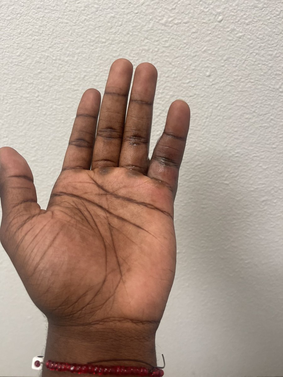 on July 8th I went to <a href="/i_CRYO_FriscoTX/">iCRYO Frisco TX</a>  to receive spot therapy for a jammed pinky finger and I left with 2nd degree burn to my pinky and ring finger. Since this incident I have been in a high state of pain with little feeling in my fingers and have been unable to sleep.