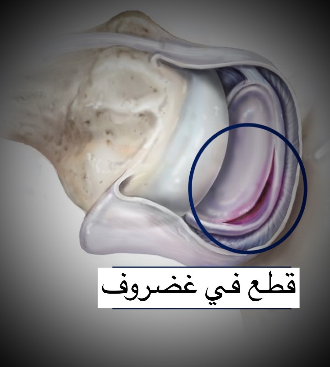 dromaralofi's tweet photo. خلع الكتف يجب ألا يتم إهماله أبداً ويحتاج لعلاج  بعد استشارة جراح عظام مختص (كتف أو اصابات رياضية الخ)

خلع الكتف أو خلع الكتف المتكرر قد يؤدي لكسر تهشمي أو لتمزق أو قطع أو تلف في أربطة / غضاريف / أوتار / مفصل الكتف وبالتالي لتفاقم المشكلة

إذا لديك خلع في الكتف راجع طبيب الآن ! https://t.co/lY7NjUwfqT