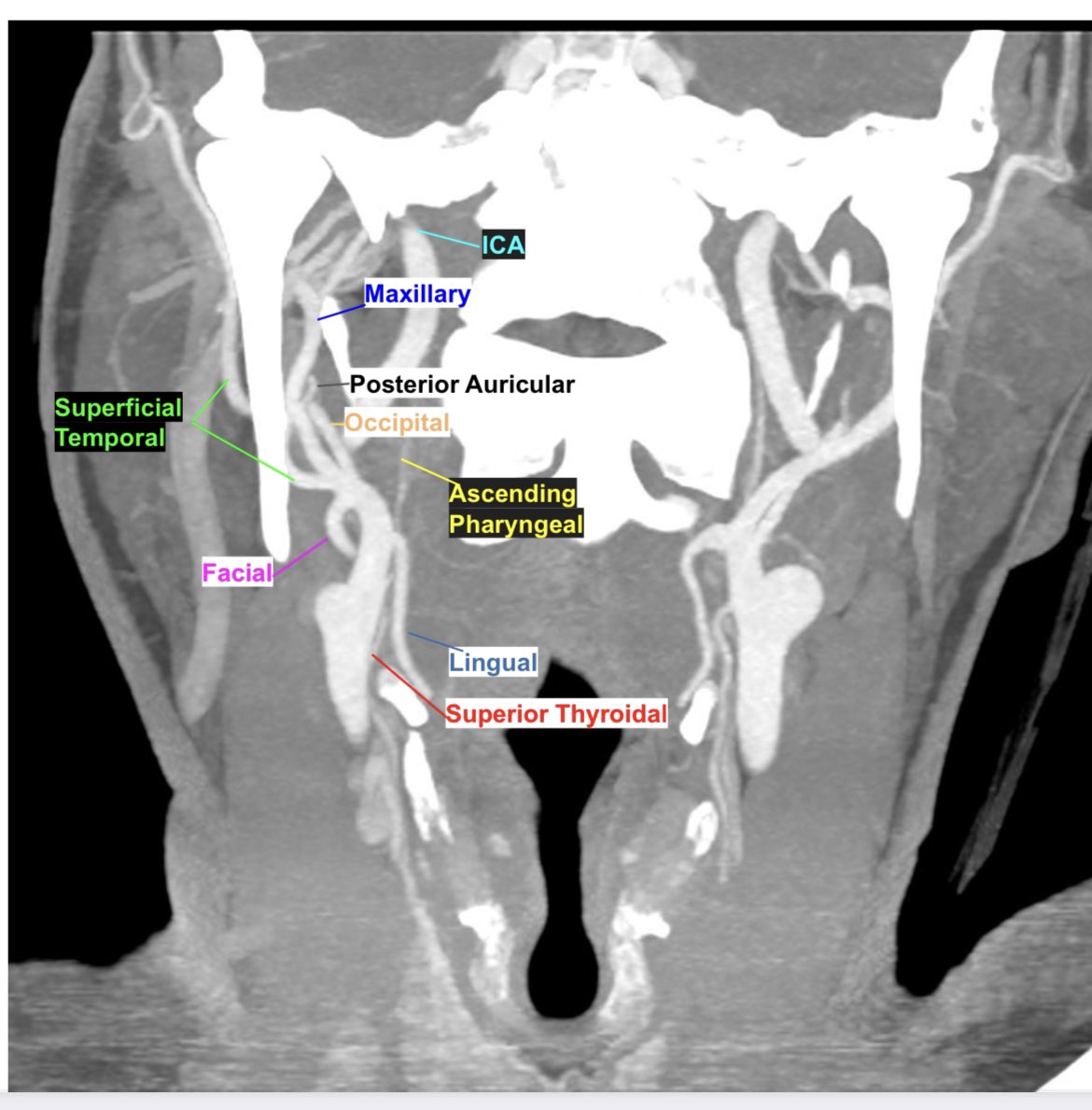 learnneurorad's tweet image. Remember the ECA branches with the mnemonic FALS MOPS to remember the first and second set of branches. While the mnemonic is not in the order of the ECA branches, one can then label the branches based on where they are headed on the CTA 🙃#mightwork #Neurorad #radres #MedEd