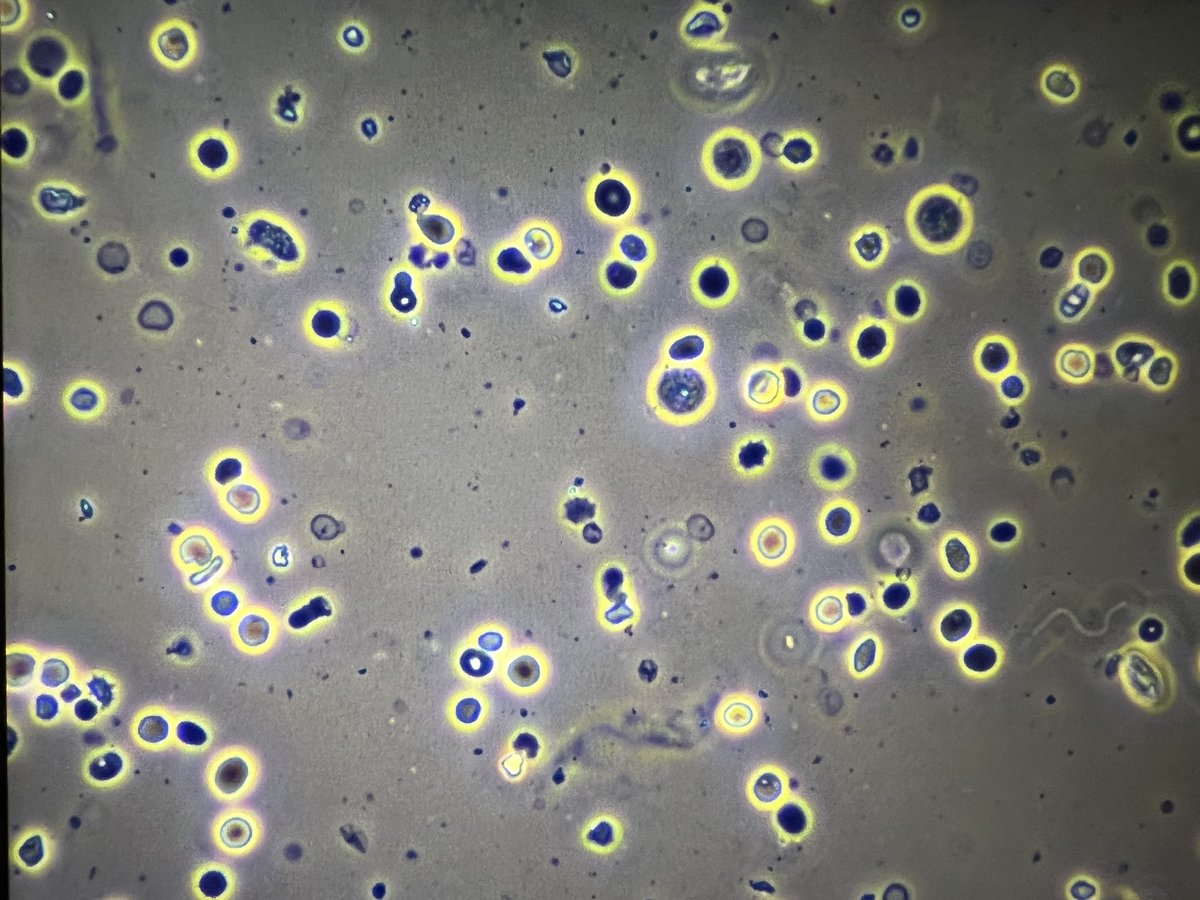 msc271's tweet photo. 81YO Caucasian woman with PMH HTN, RA, HLA-B27+, ovarian CA, DVT/PE who presented due to acute anemia on routine labs and admitted for AKI. Serologies + for MPO #UrineMicroscopy #UrinarySediment #Acanthocytes #AAV https://t.co/exTazwoCtx