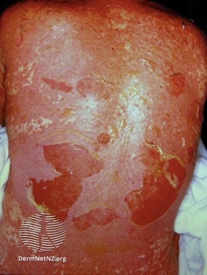 DrStevenTChen's tweet photo. Reminder that #dermatology is not just acne and warts. Yes, those are all important, but we as dermatologists see some really rare &amp; serious medical stuff!

For example, my typical week will include:
Pemphigus (pic 1)
Pemphigoid 
GVHD
Sezary
SJS (pic2)
DRESS
Hidradenitis (pic3) https://t.co/aj7jRkMX68