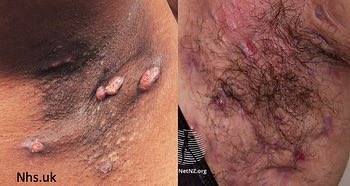 DrStevenTChen's tweet photo. Reminder that #dermatology is not just acne and warts. Yes, those are all important, but we as dermatologists see some really rare &amp; serious medical stuff!

For example, my typical week will include:
Pemphigus (pic 1)
Pemphigoid 
GVHD
Sezary
SJS (pic2)
DRESS
Hidradenitis (pic3) https://t.co/aj7jRkMX68