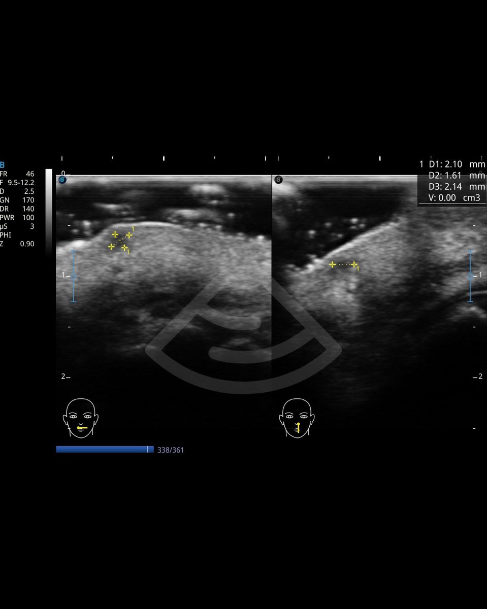 ¿Tendré que tirar hate para viralizar estas imágenes de ultrasonido de labios donde identificamos una vacuola de ácido hialurónico que estaba causando inconformidad en la paciente?

Mejor entérense que el #ultrasonidofacial existe 🤓

#POCUS #ultrasonido #ultrasound