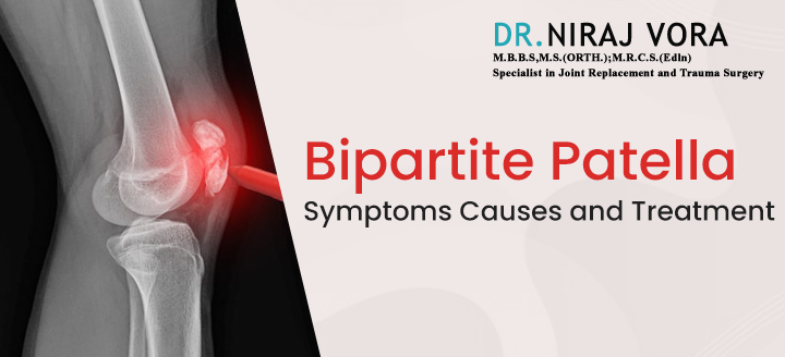 #BipartitePatella Symptoms Causes and Treatment

The #KneeCap (Patella), at birth is a combination of two separate bones which eventually fuse at birth to become a single unit..
Know more at: drnirajvora.co.in/bipartite-pate…