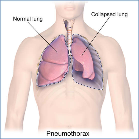 MedStudentNote1's tweet photo. 🩺🧑🏻‍⚕️Diagram of the Hour: Pneumothorax

📑🤓 For medical study resources, check out our High-Yield PDF Medical Study Notes, available here 👉 https://t.co/NvqXYlgBzv 👈

🚨Get 80% OFF our Entire Bundle Deal Today!🚨

#medstudentnotes #medstudent #medicalstudent #MDstudent https://t.co/iSSZ0Xb1dy