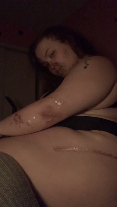 I&rsquo;ve got scars on my left hip, left arm, right hand, and right foot from surgeries, but I think they<a href="/tag/shibari"class="tags"><span>#shibari</span></a>