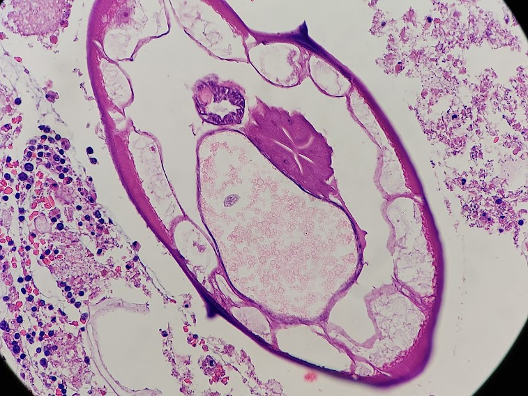 padmapathology1's tweet image. #pathresidents #TooGoodNotToShare
#IDpath #Enterobius