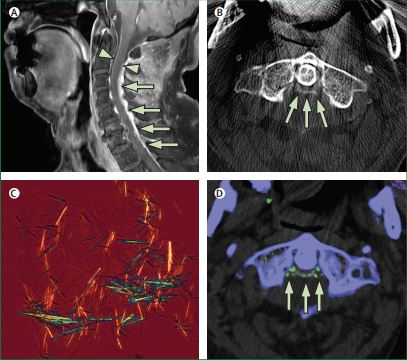 Picture Quiz—An 85-year-old man with a 5-day history of persistent fever and severe neck pain presented to hospital. No bacteria were identified in the culture test including cerebrospinal fluid. What is the diagnosis? thelancet.com/doi/story/10.1…