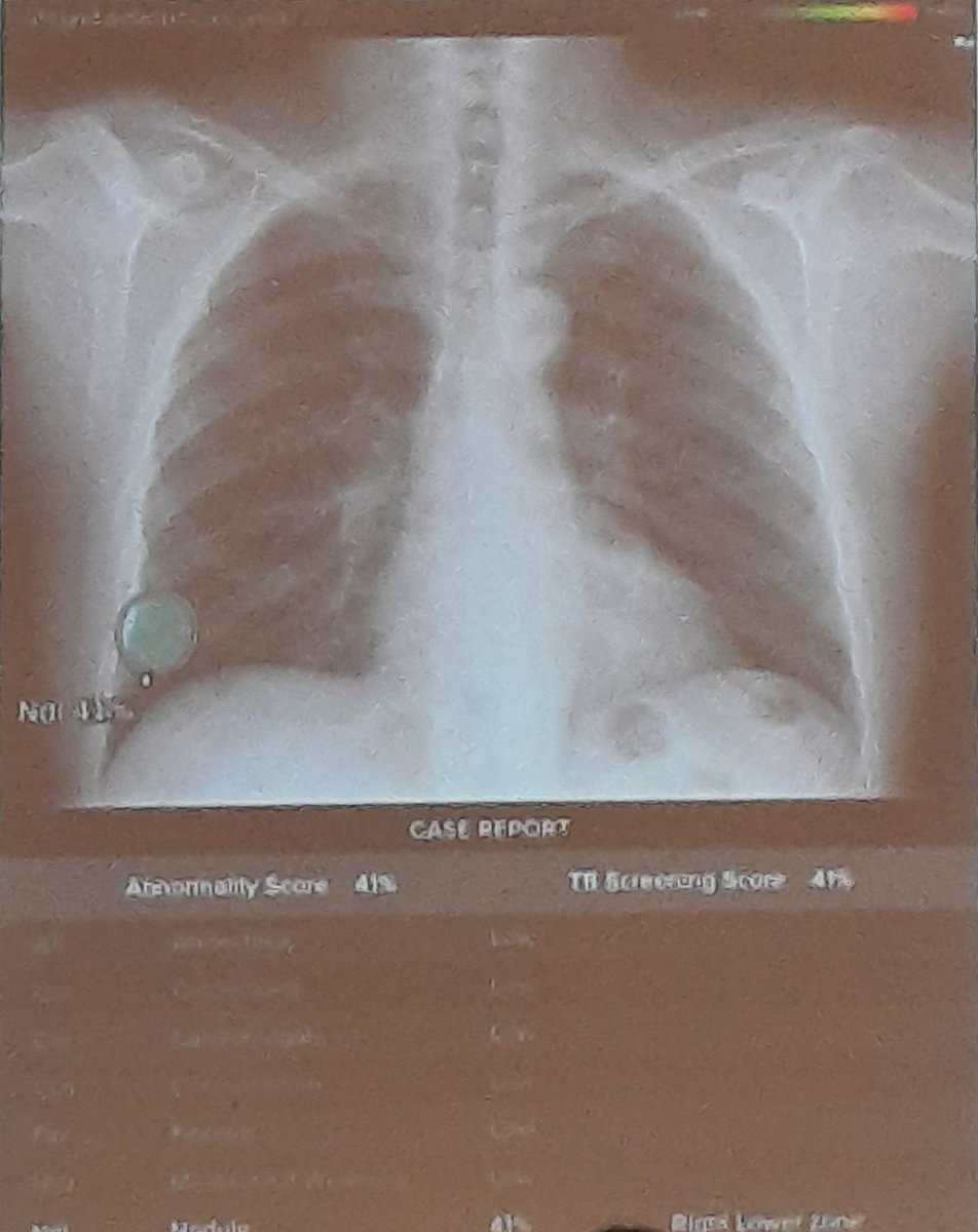 Casos de Éxito de #AI Inteligencia Artificial en la #Medicina. #CatedraAI #UnivBurgos <a href="/UBUEstudiantes/">Universidad Burgos</a>  <a href="/LaPaz2030/">Hospital La Paz 2030</a> Curso Investigar Aplicando Inteligencia Artificial. #IFIE
bitly.ws/LgWE
#BeChange