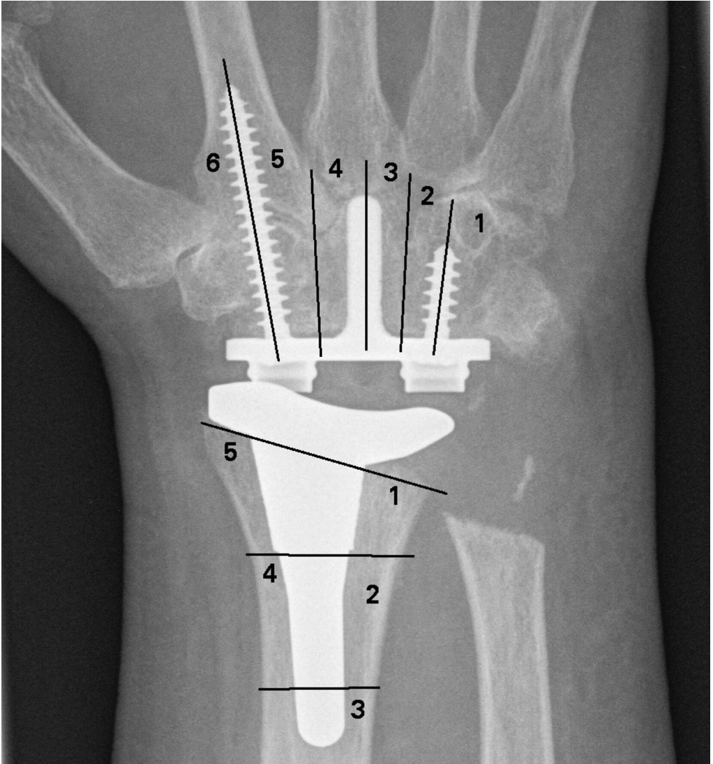 JHSEur's tweet photo. Do you know about the Wrightington classification of zonal loosening for the Universal 2 implant?

Read the paper below ⬇️ https://t.co/eOpaz4iEGm
