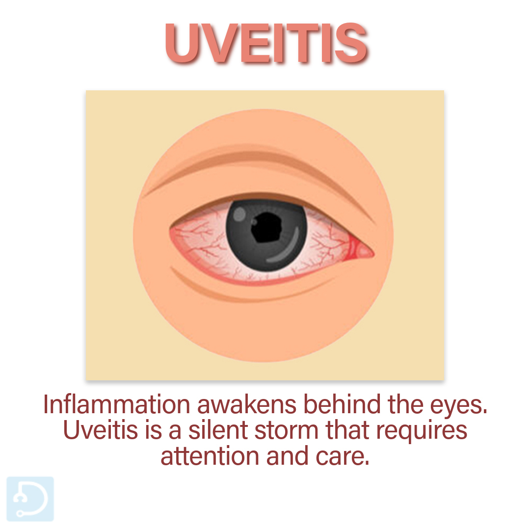 Don't ignore uveitis signs. You may experience pain, redness, and changes in your vision.

Click here 🔗bit.ly/3D9yA3K to learn more 🔖📚

#Uveitis #EyeHealth #MedTwitter #Docsteth #Inflammation #VisionCare #UveitisAwareness #EyeCare #EyeExams #HealthyVision