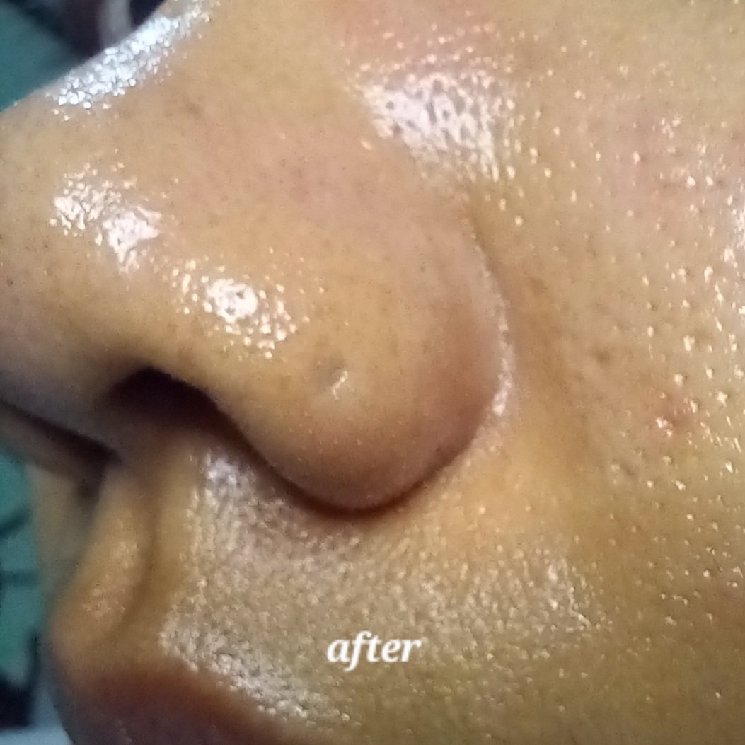 Satisfying banget tiap pake clay mask ini 😆

Keliatan banget dia menyerap sebum dari pori2. Makanya keliatan bintik2 kaya gini⤵️

Abis dibilas langsung melek karena seadem itu maskernya! 🥶
#racuninskincare