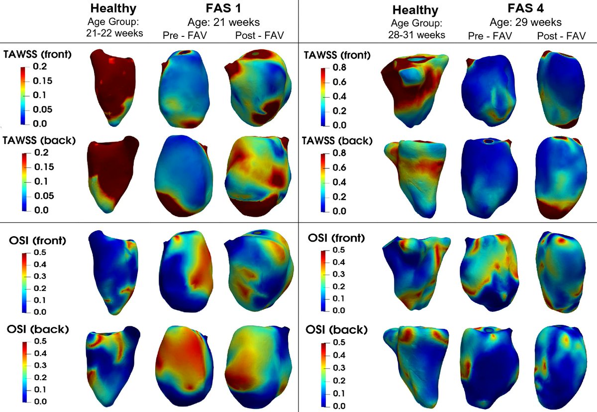 Fluid Mechanical Effects of Fetal Aortic Valvuloplasty for Cases of Critical Aortic Stenosis with Evolving Hypoplastic Left Heart Syndrome <a href="/ChoonHwaiYap/">Choon Hwai Yap</a> 
<a href="/ImperialBioeng/">Imperial Bioengineering</a> <a href="/jkulinz/">JKU - Johannes Kepler Universität Linz</a> <a href="/BMESociety/">Biomedical Engineering Society</a> <a href="/SpringerNature/">Springer Nature</a> 

Link: rdcu.be/dgKxu