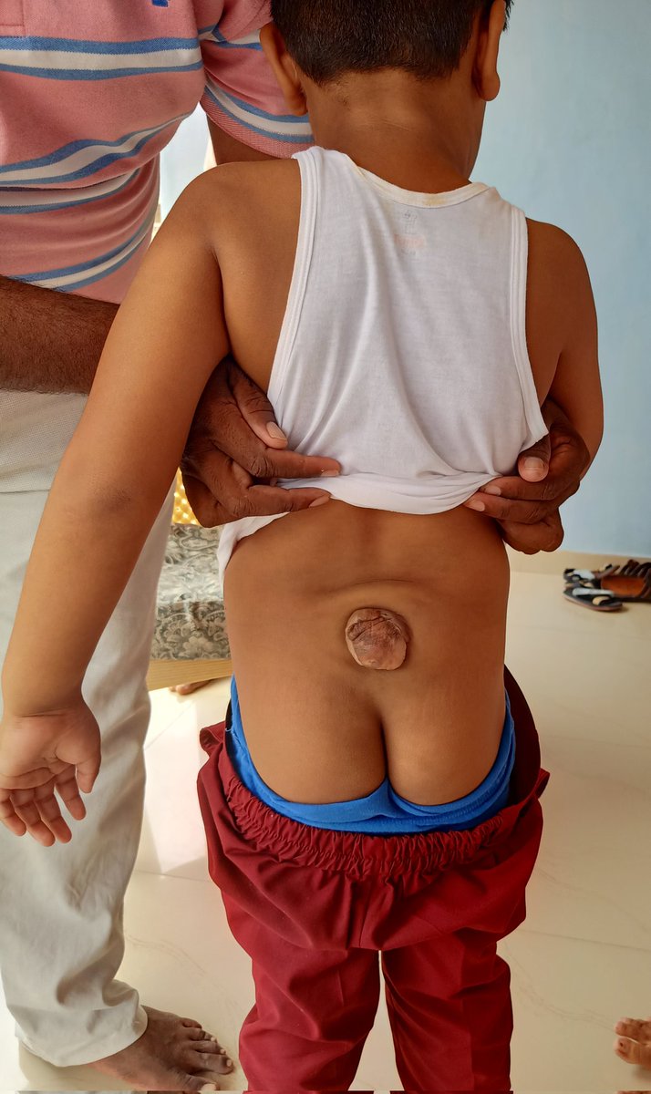 HiralSengal's tweet photo. Today visited Successfully OT done "Meningomylocel " Congenital birth defect. #my own world # RBSK # 
@CMOGuj @DDOCUdepur @dieco_cu_health @RChhotaudepur @GujaratRbsk @SbccBodeli @bodeli_live https://t.co/wcz8ifADh0