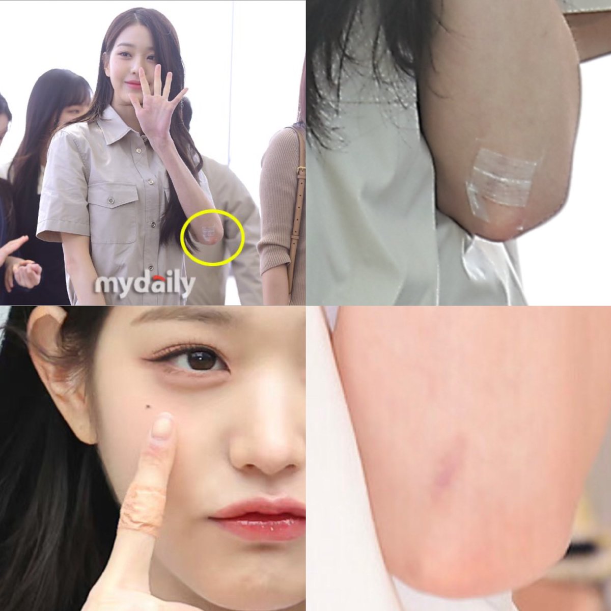 OrangeZ0122's tweet photo. @IVEstarship So she got hurt, and all the fans didn't know⁉️Wonyoung went to the emergency room to get her wound stitched up to match the team's progress, and just got 14-second lyrics and a standing in corner choreography⁉️@IVEstarship 
#장원영 #WONYOUNG_BetterTreatment https://t.co/NaU1ZeRziK