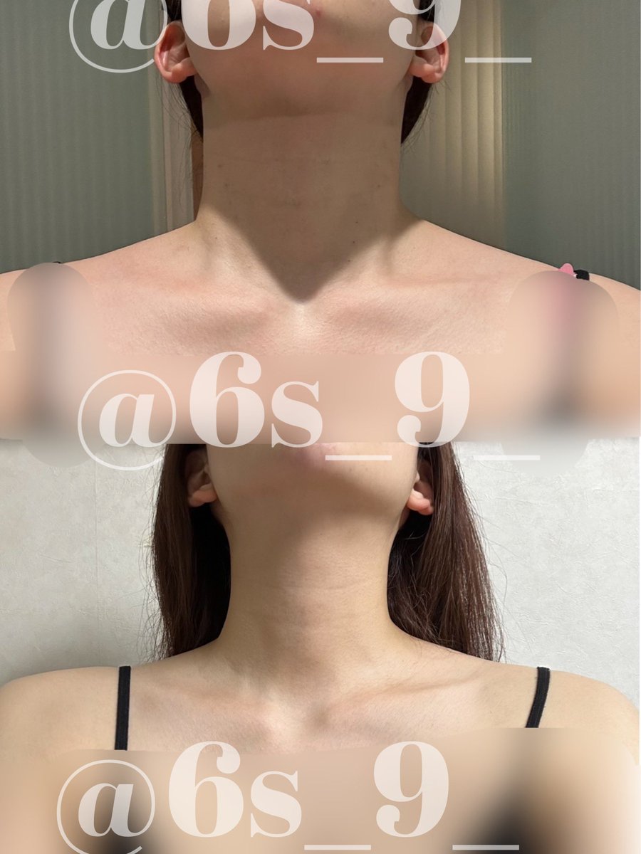 6s_9_'s tweet photo. 肩凝りやばすぎて肩首ボトックス打ったんだけど全くなくなって毎日快適＼(^o^)／
見た目も変わってきて嬉しい https://t.co/EOfXJyhDlt