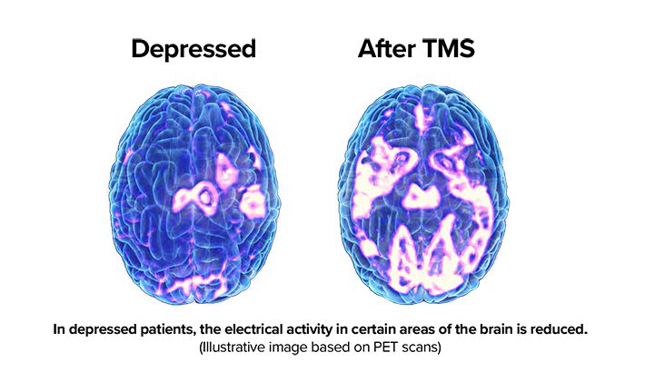 Used for adults with Major Depressive Disorder, Transcranial Magnetic Stimulation (TMS) is a non-invasive treatment option that uses short, repetitive pulses of magnetic energy to stimulate nerve cells in the brain 🧠. 

Learn more at WVUMedicine.org/TMS.