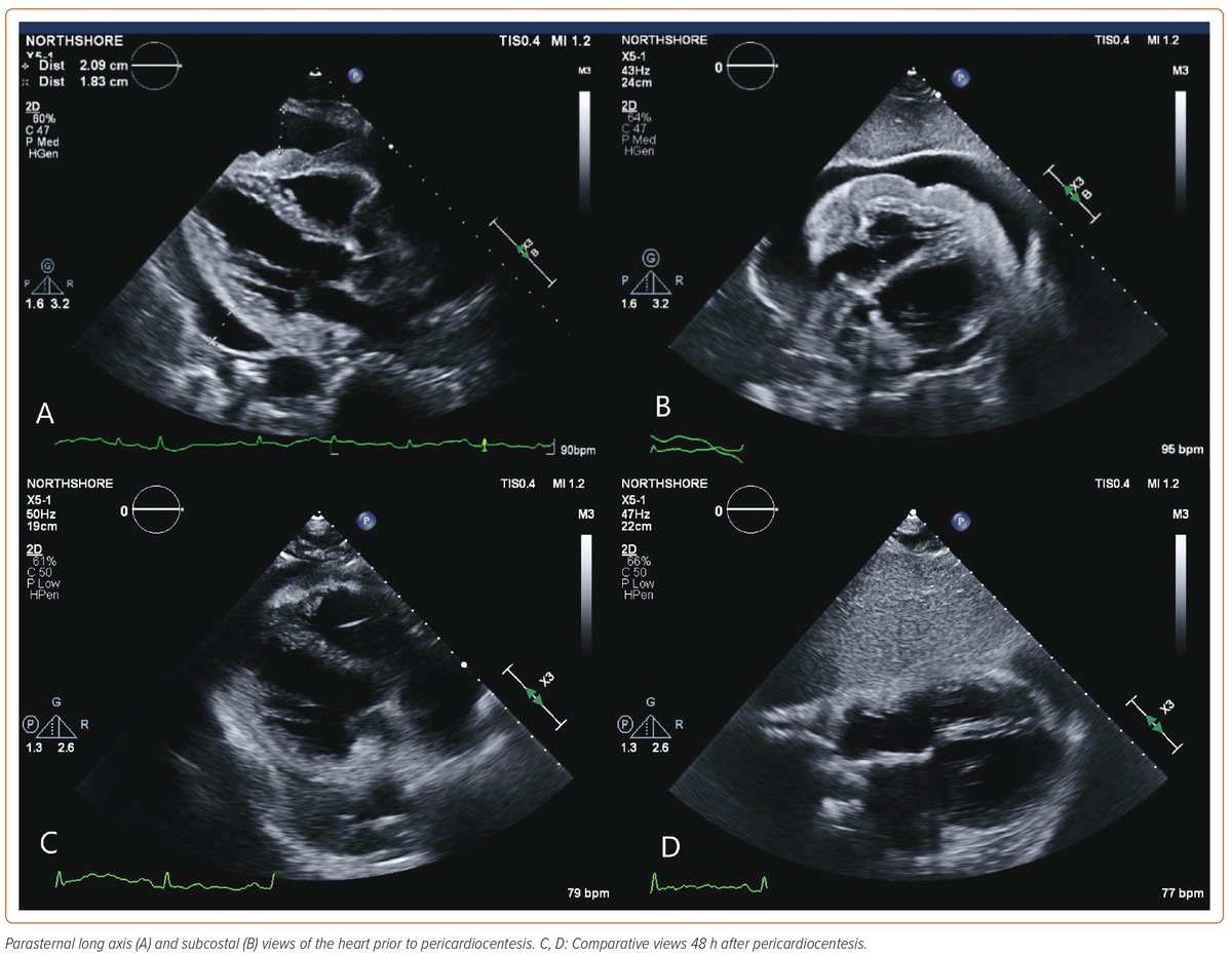 ❤️‍🔥#USCardiology & @CardioNerds co-published Case Report Alert‼️ @radcliffeCARDIO 📝A Case of Primary Cardiac B-cell Lymphoma by @CardioloLee @IvaMD_Cardio @jpsalazaradum, Dr. Eryn Cameron, & @AmitPursnaniMD 🔗uscjournal.com/articles/case-…