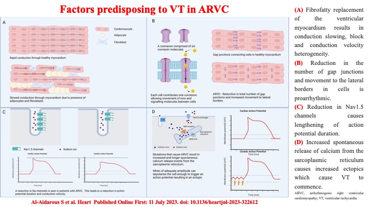 📌 ARVC
👉 Factors predisposing to VT
#ARVC #CardioTwitter #SportsCardiology #Review @DrRoderickTung @PrashSanders @AndrewKrahnMD @shivkumarmd @Dr_Santangeli @DrFerminGarcia @JagSinghMD @DrJasonAndrade @DhirajGuptaBHRS @DoctorPhillEP @ftrae @SeguraCardio @MJAckermanMDPhD @omwazni