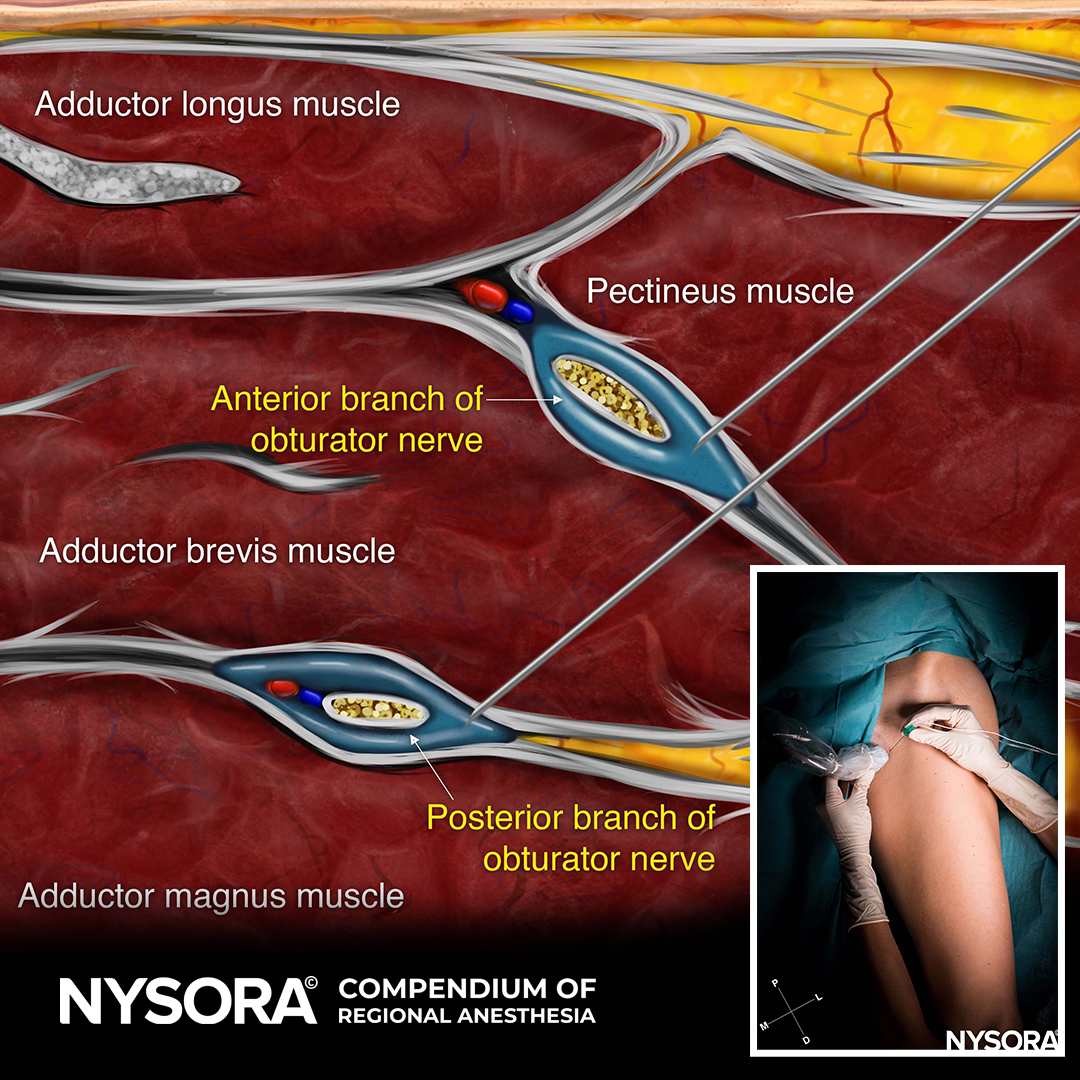 📚 Exciting news from NYSORA's Compendium of Regional Anesthesia! 🌟 We've added fresh content to take your knowledge. Start your FREE trial of the Compendium today: bit.ly/3JuovCO

#nysora #anesthesia #anesthesiology