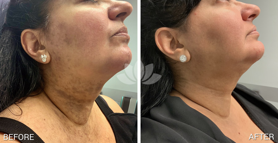 HighlyRatedPros's tweet photo. Female patient treated with PicoWay at Sunset Dermatology in South Miami, FL. Check monthly promotions and more before and after pictures of general dermatology and cosmetic treatments at: https://t.co/2eDNbR1rRZ

#dermatologistsouthmiami #southmiami #dermatologist #picoway https://t.co/tf0Cx5oU0n