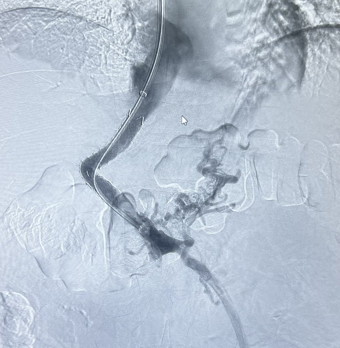 BasavaRaj_IR's tweet photo. #tipss TIPSS in refractory ascites with partial Pvt . When conventional transjugualr access is not going your way.
Percutaneous access - Portal vein to hepatic vein - gunshot tech.
Percutaneous
#tipss #stent https://t.co/2mUkTT5XLf