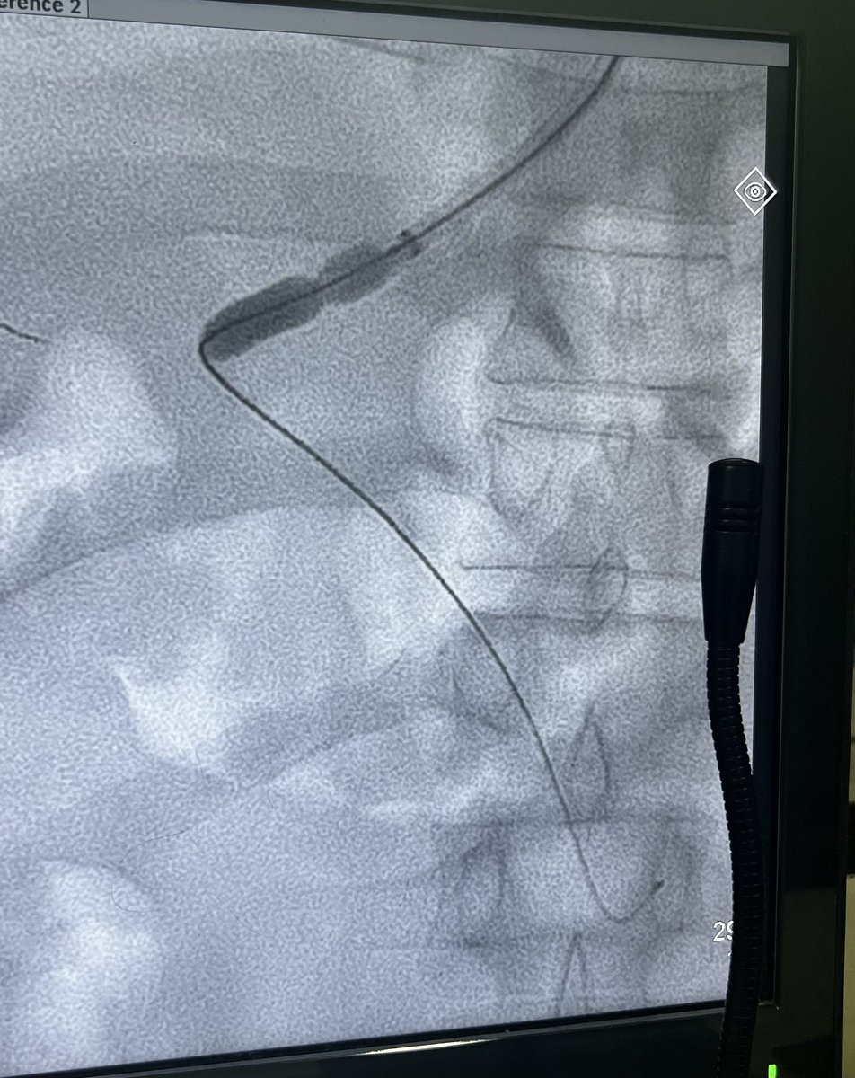 BasavaRaj_IR's tweet photo. #tipss TIPSS in refractory ascites with partial Pvt . When conventional transjugualr access is not going your way.
Percutaneous access - Portal vein to hepatic vein - gunshot tech.
Percutaneous
#tipss #stent https://t.co/2mUkTT5XLf