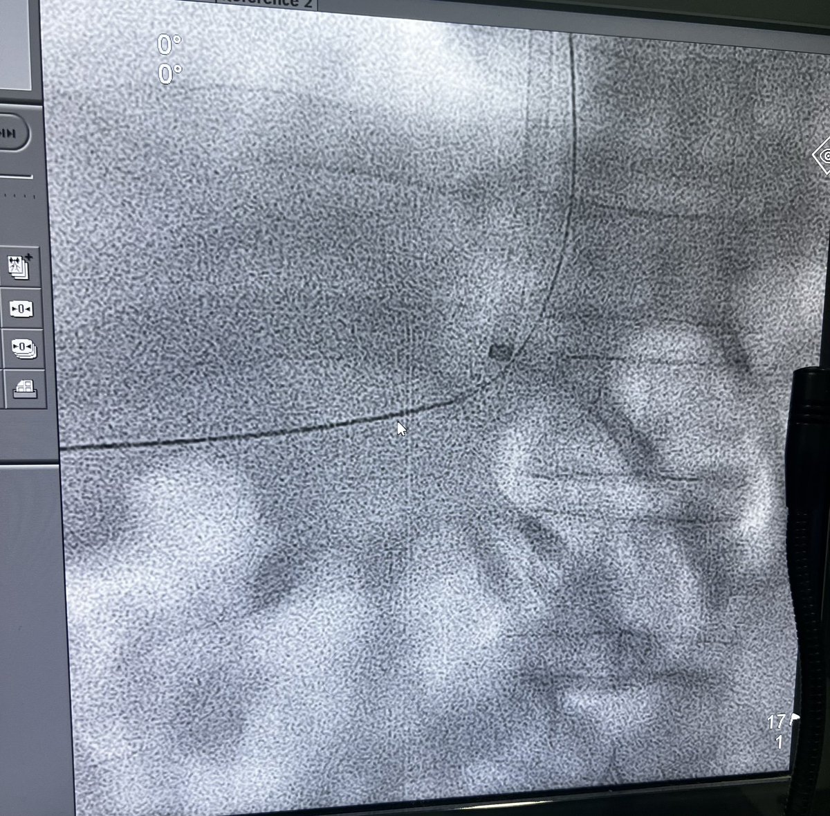 BasavaRaj_IR's tweet photo. #tipss TIPSS in refractory ascites with partial Pvt . When conventional transjugualr access is not going your way.
Percutaneous access - Portal vein to hepatic vein - gunshot tech.
Percutaneous
#tipss #stent https://t.co/2mUkTT5XLf