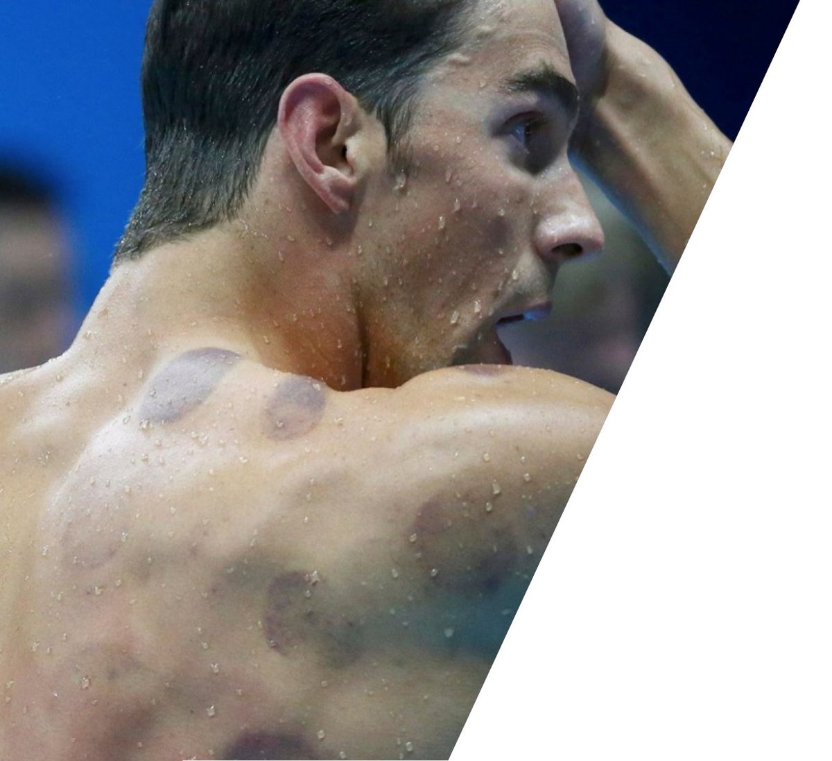 Here's one of the best (highest-quality) studies on #cupping therapy. Relative to sham, it shows no effect of cupping on pain, physical function, perceived overall effect, quality of life, psychological symptoms, or medication use. #pseudoscience

🔓rb.gy/nb178