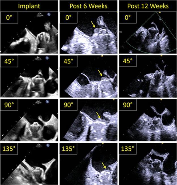 American Society of Echocardiography (@ase360) on Twitter photo We report two cases of percutaneous left atrial appendage (LAA) closure using the new Watchman FLX device leading to Device-Associated Thrombus (DAT) in the setting of nonadherence with oral anticoagulation.
Read our <a href="/CASEfromASE/">CV Case Journal</a> article: bit.ly/44ptPPF We report two cases of percutaneous left atrial appendage (LAA) closure using the new Watchman FLX device leading to Device-Associated Thrombus (DAT) in the setting of nonadherence with oral anticoagulation.
Read our <a href="/CASEfromASE/">CV Case Journal</a> article: bit.ly/44ptPPF