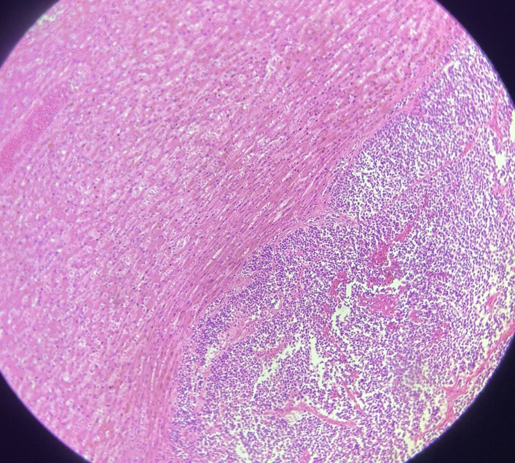 BizzarePath's tweet photo. Small cell carcinoma of lung, liver metastasis #PathTwitter #MedTwitter https://t.co/QKExFBey09