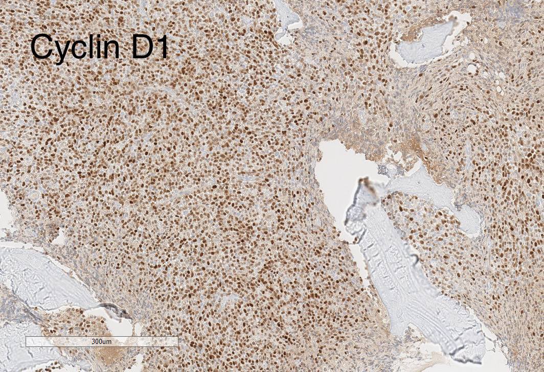 sanamloghavi's tweet photo. #hemepath pitfall series
Did U know that hairy cell leukemia 👇🏻 is + for Cyclin D1 by IHC?? Well U do now😉
But unlike mantle cell lymphoma &amp; myeloma (some) hairy cell leukemia does not have a IGH::CCND1 translocation
So remember: not all that is cyclinD1+ is mantle cell lymphoma https://t.co/LmSpXDsyCX
