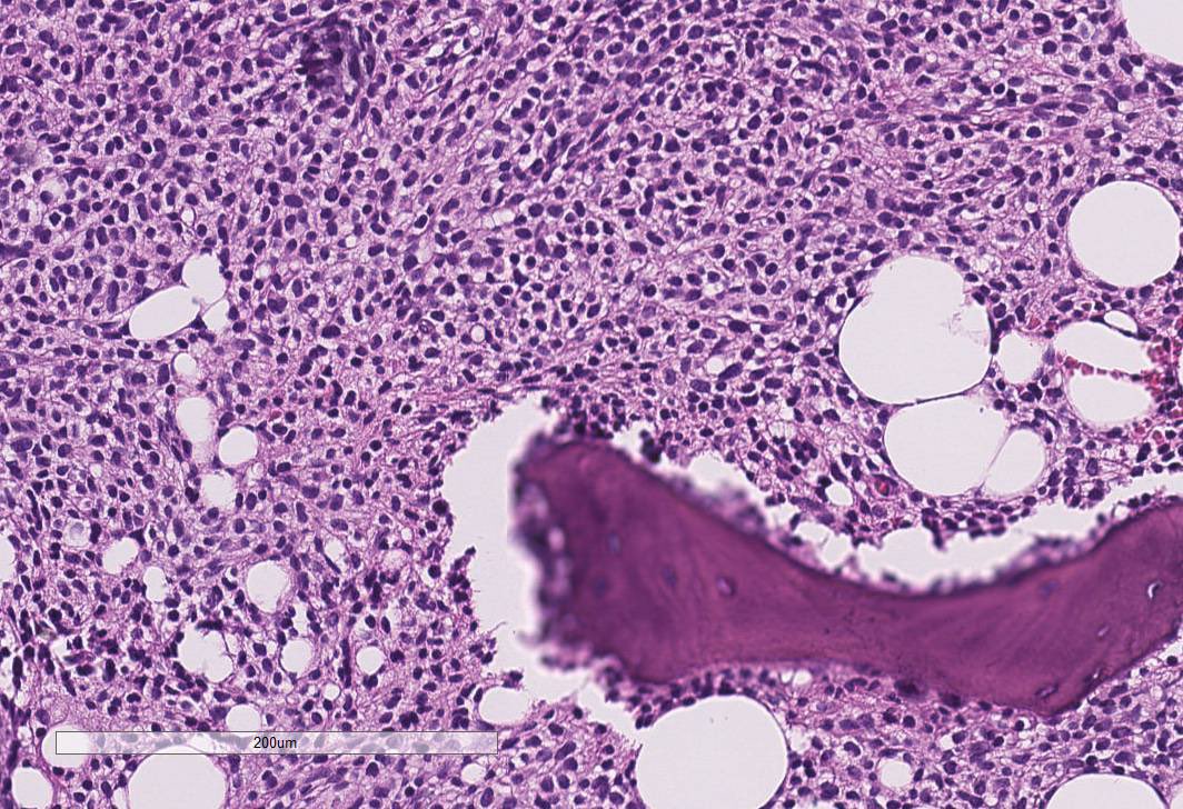 sanamloghavi's tweet photo. #hemepath pitfall series
Did U know that hairy cell leukemia 👇🏻 is + for Cyclin D1 by IHC?? Well U do now😉
But unlike mantle cell lymphoma &amp; myeloma (some) hairy cell leukemia does not have a IGH::CCND1 translocation
So remember: not all that is cyclinD1+ is mantle cell lymphoma https://t.co/LmSpXDsyCX