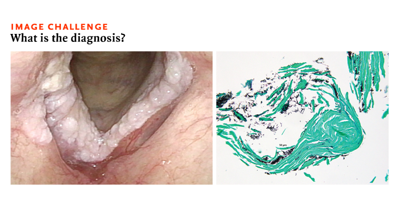 NEJM's tweet photo. A 78-year-old man with chronic obstructive pulmonary disease (COPD) presented with a 2-month history of dysphonia. Read the full case details and submit your answer or see how others answered: https://t.co/yRifmSBk0e