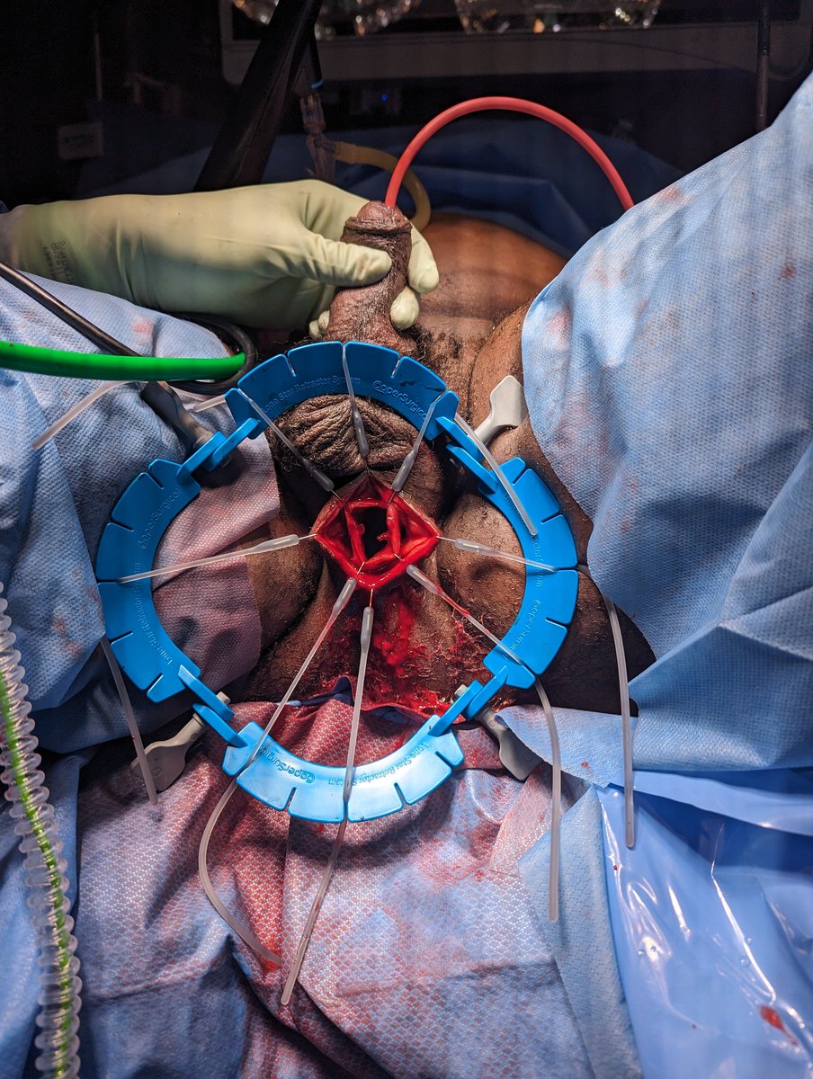KirtishriM's tweet photo. Poorly controlled diabetic with recurrent perineal abscess for over a decade. Recently admitted with sepsis. Most surprising was the thickness and the epithelialization of this periurethral abscess sac!! 😶‍🌫️ Of course we'll come back to fix the stricture... @CaseUrology https://t.co/jtEwvhSJSP