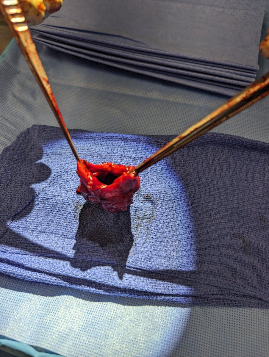 KirtishriM's tweet photo. Poorly controlled diabetic with recurrent perineal abscess for over a decade. Recently admitted with sepsis. Most surprising was the thickness and the epithelialization of this periurethral abscess sac!! 😶‍🌫️ Of course we'll come back to fix the stricture... @CaseUrology https://t.co/jtEwvhSJSP