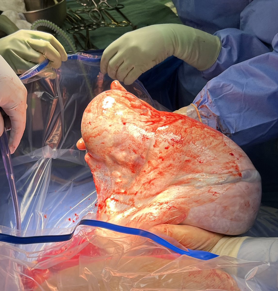 fmelius's tweet photo. Here’s a fun one! Sharing with permission. I delivered this term baby by cesarean. I got her out of the abdomen still in her amniotic sac. This is extremely rare. It’s called “en caul”. Thought to be good luck.
Hope you’re having a fun day! #encaul #cesarean #obstetrics https://t.co/PfJ6XqrgMY