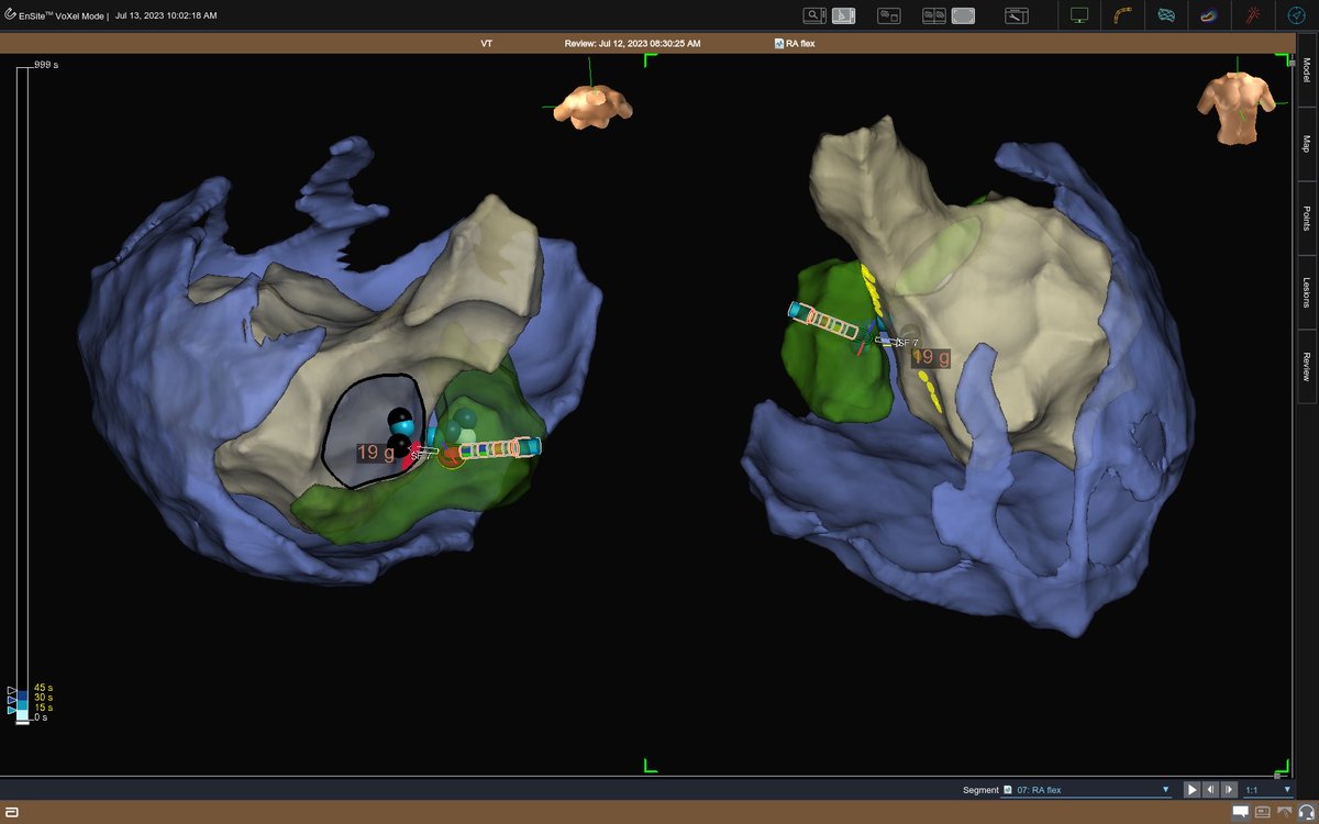 Filippo Maria Cauti (@filippocauti) on Twitter photo Unipolar sequential RF ablation from posterosuperior LV process (gray) and right atrium (green) for fast VT performed yesterday with <a href="/PaoloDellaBell1/">Paolo Della Bella</a> <a href="/SanRaffaeleMI/">Ospedale San Raffaele</a> 9mm anatomical space for non inducibility with #Tactiflex <a href="/fedecalore/">Federico Calore</a> <a href="/AbbottCardio/">Abbott Cardiovascular</a> Unipolar sequential RF ablation from posterosuperior LV process (gray) and right atrium (green) for fast VT performed yesterday with <a href="/PaoloDellaBell1/">Paolo Della Bella</a> <a href="/SanRaffaeleMI/">Ospedale San Raffaele</a> 9mm anatomical space for non inducibility with #Tactiflex <a href="/fedecalore/">Federico Calore</a> <a href="/AbbottCardio/">Abbott Cardiovascular</a>