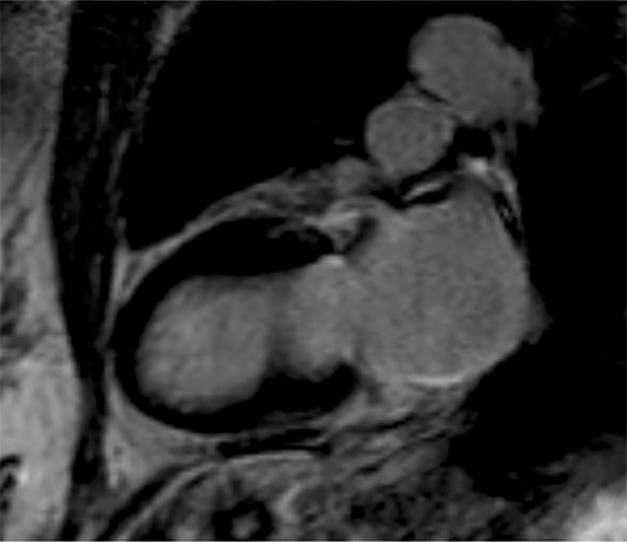 NEW PUBLICATION
📜Association between Left Atrial LGE and Atrial Fibrillation
🔹Post-hoc analysis of the MESA cohort study found left atrial LGE at 2D #WhyCMR helped predict atrial fibrillation.
⛓️doi.org/10.1148/ryct.2…